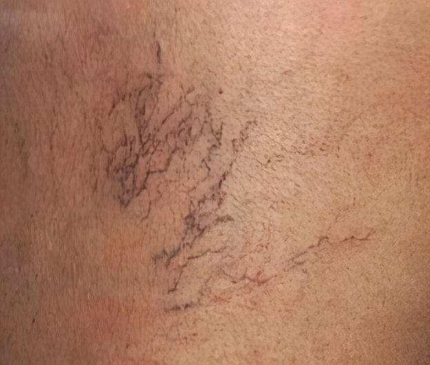 spider-veins Spider Veins