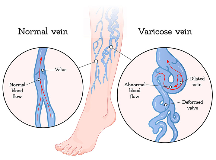 varicose-veins-2 Normal Vein vs Varicose Vein