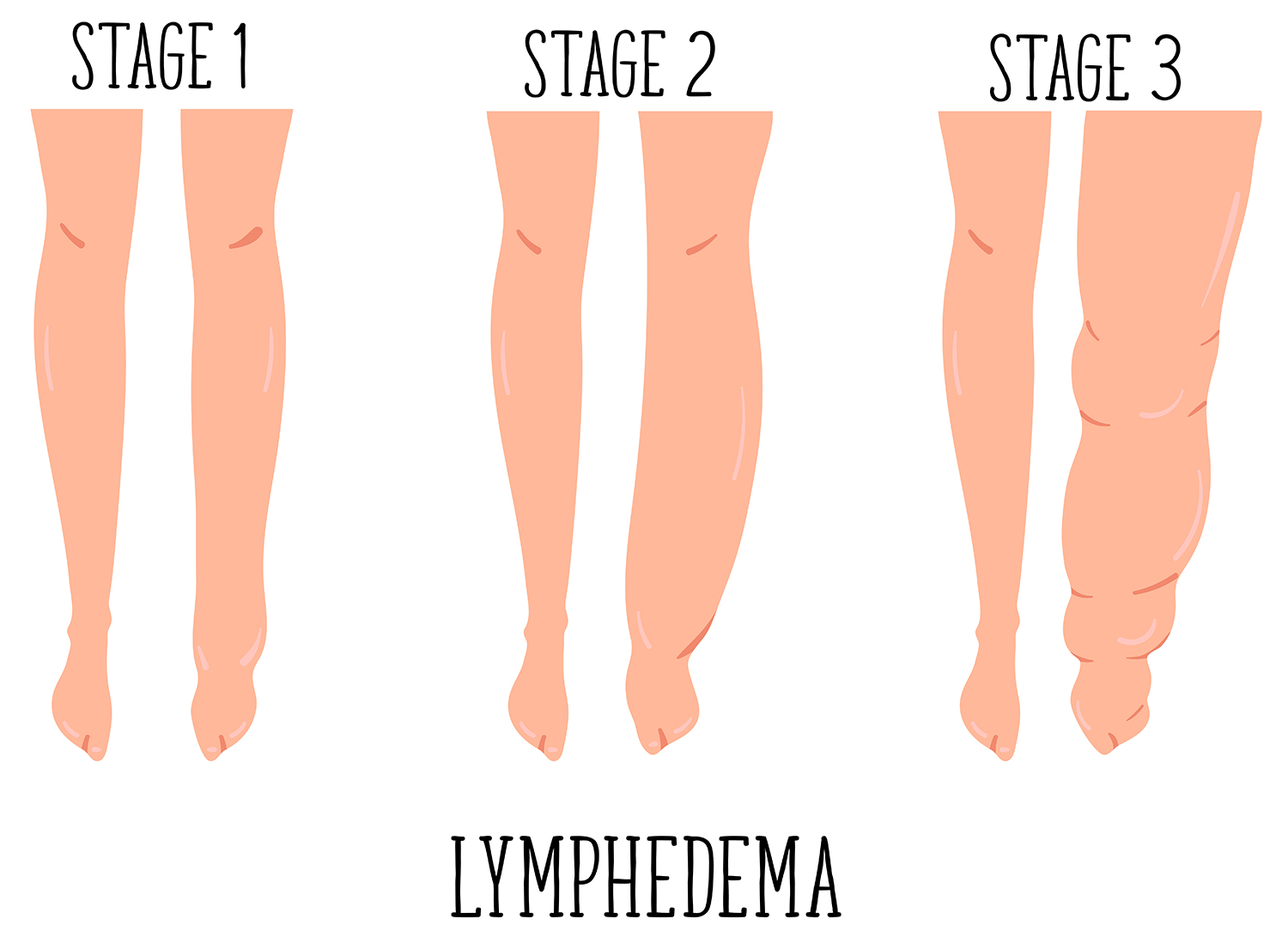 Three Stages of Lymphedema