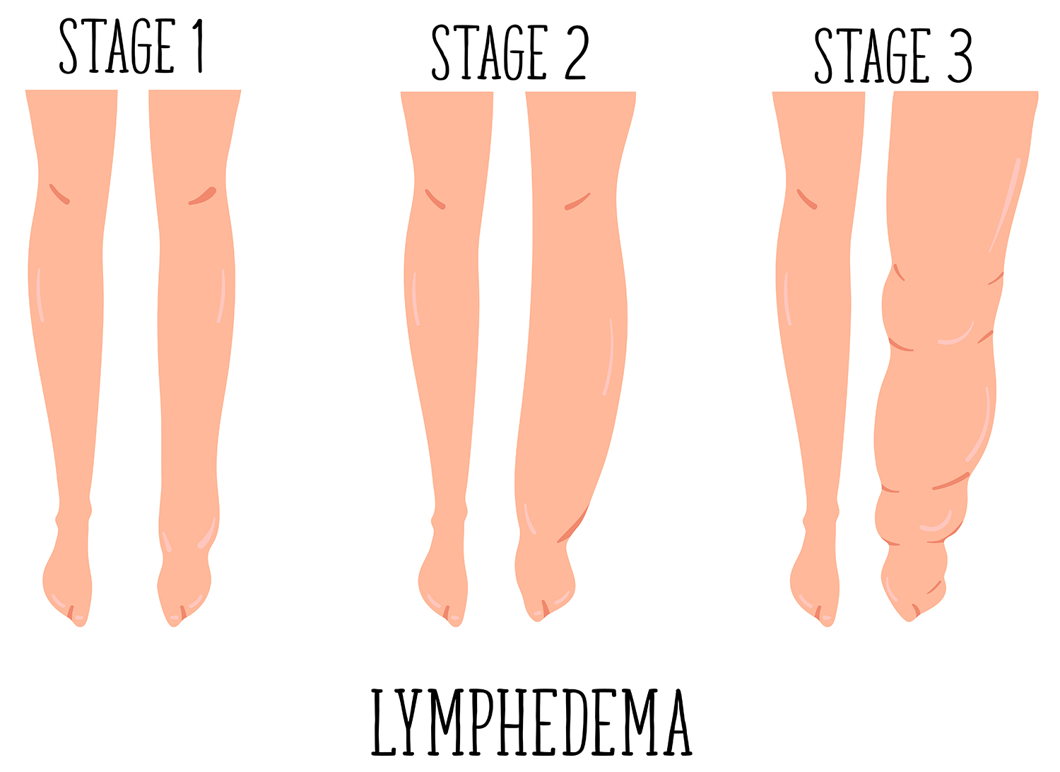 Lymphedema Presents Therapeutic Challenges Lymphedema - vrogue.co