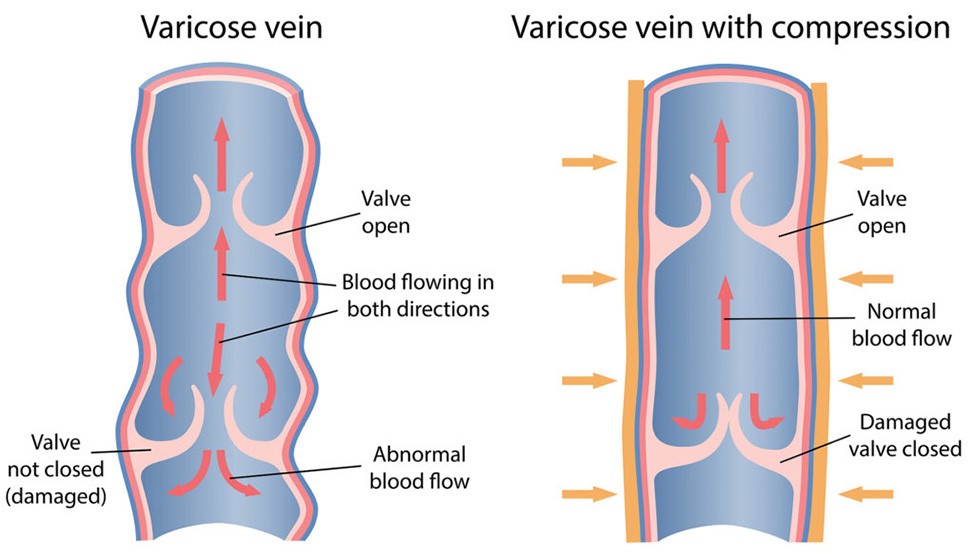 Varicose Vein vs Varicose Vein with Compression Varicose Vein vs Varicose Vein with Compression