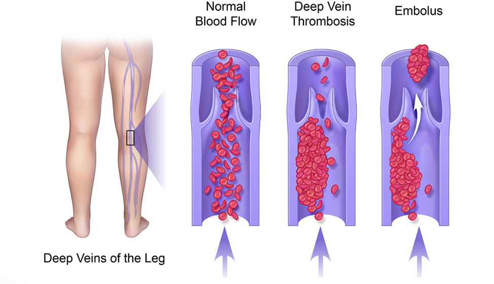 Pulmonary embolism