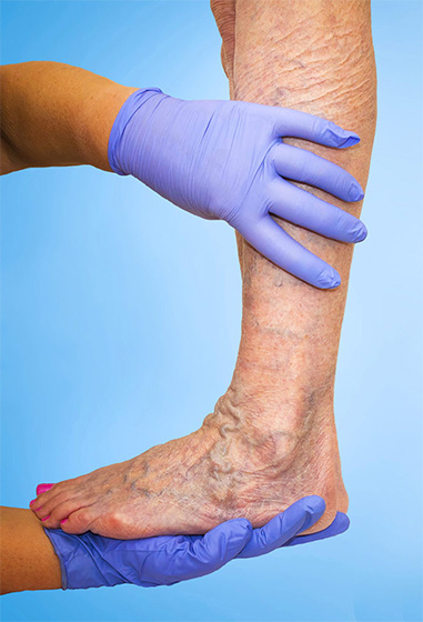 gloved-hands-with-leg Chronic Venous Disease