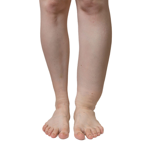 lymphedema Lymphedema