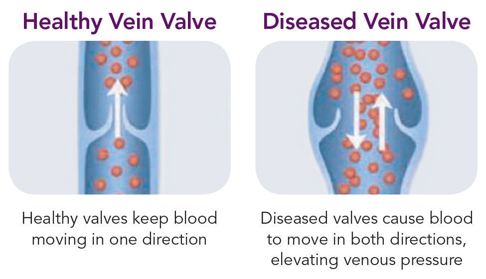 Healthy Vein Valve vs Diseased Vein Valve