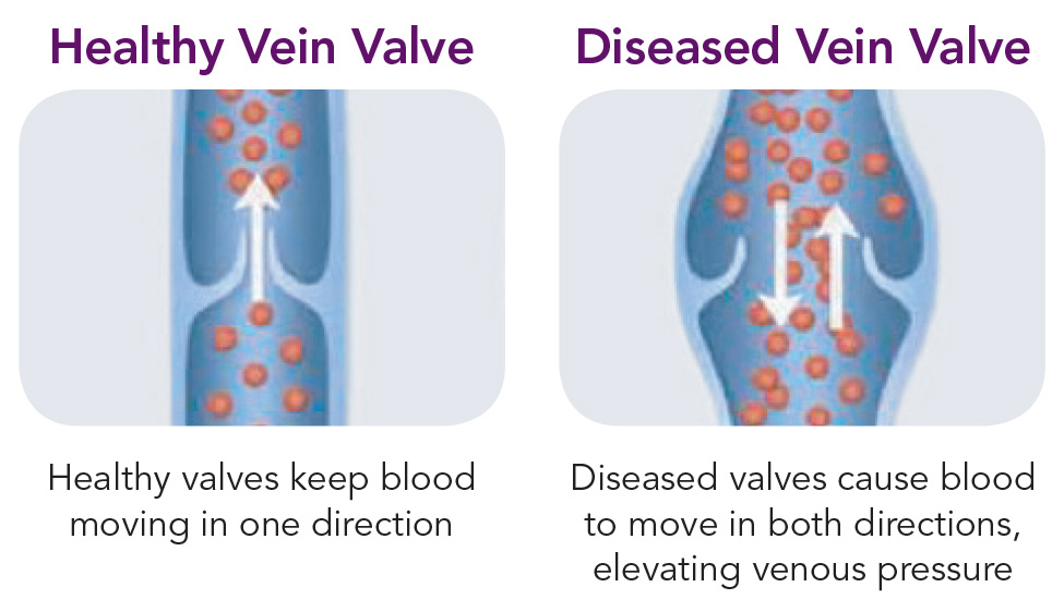 venous-reflux Healthy Vein Valve vs Diseased Vein Valve