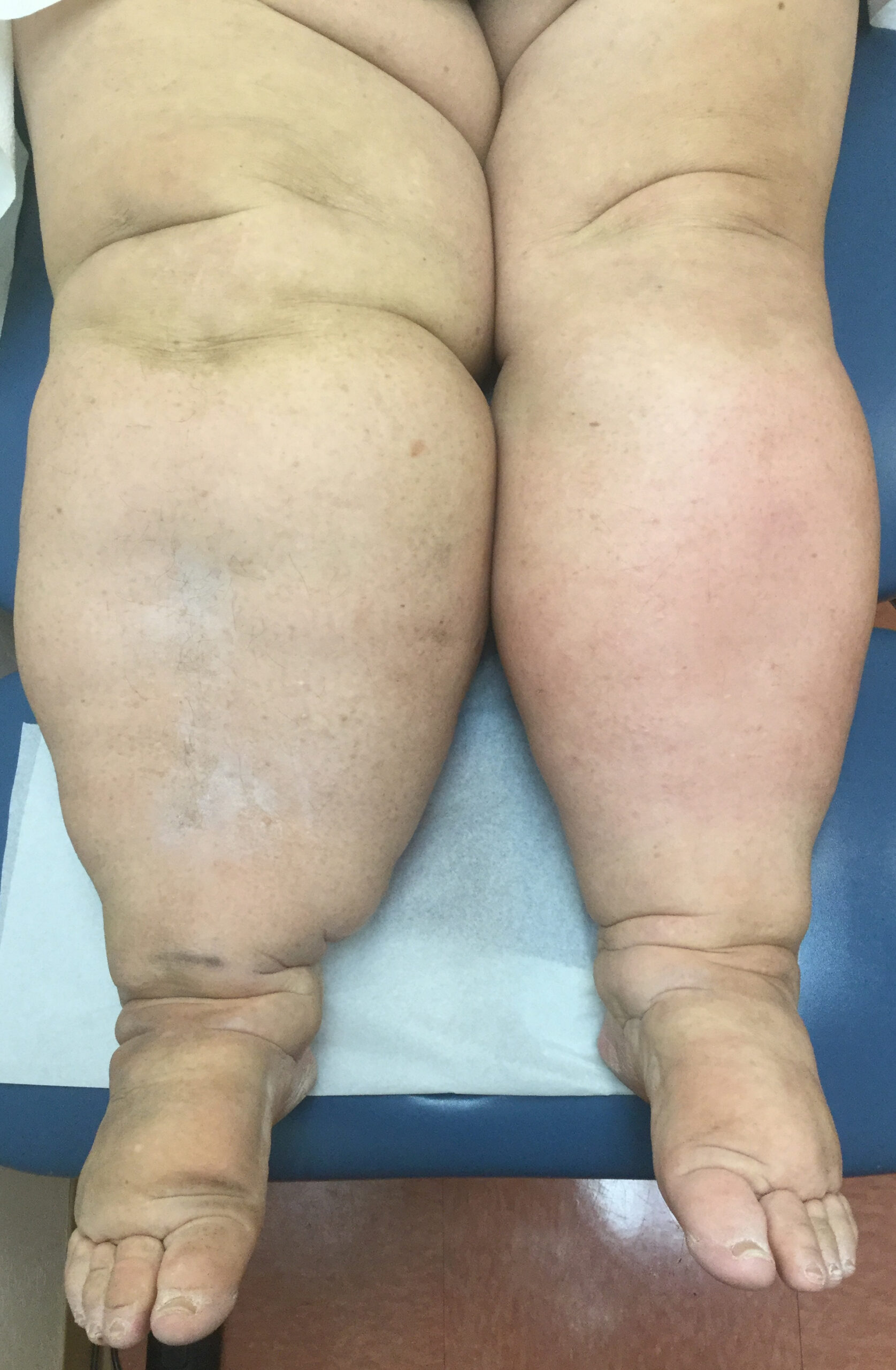 lymphedema Lymphedema